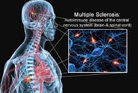 Uhthoff's phenomenon (also known as uhthoff's syndrome, uhthoff's sign, and uhthoff's symptom) is the worsening of neurologic symptoms in multiple sclerosis (ms) and other demyelinating diseases when the body is overheated. Ø§Ø¹Ø±Ø§Ø¶ Ø§Ù„ØªØµÙ„Ø¨ Ø§Ù„Ù…ØªØ¹Ø¯Ø¯ Ms Ø§Ù„ÙŠÙˆÙ… Ø§Ù„Ø³Ø§Ø¨Ø¹