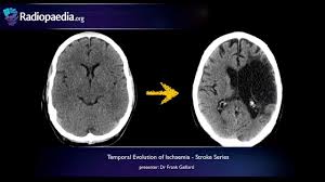 Learn how this test works, as well as its benefits and risks. Ischemic Stroke Radiology Reference Article Radiopaedia Org