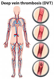 Deep Vein Thrombosis Anatomy Vector Free Download