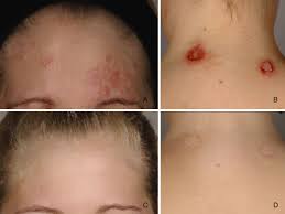 Image result for Secondary Syphilis