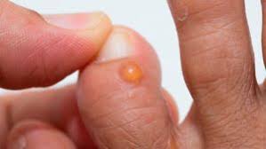 Image result for pompholyx soles of feet