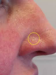 Image result for skin cancer on nose pimple