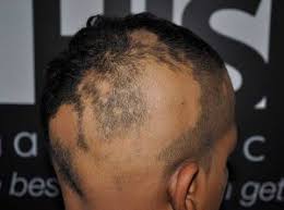 Drugs cause hair loss by interfering with the normal cycle of scalp hair growth. Alopecia Areata In Children Causes Symptoms Treatment