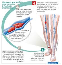 Avec la chaleur, avec des. Comment Reconnaitre Une Phlebite