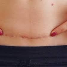 Coupure, écorchure, cicatrice…les bons réflexes pour accélérer la réparation. Le Bain De Sonia La Plus Belle Des Cicatrices Vous Avez Donne La Vie Le Bebe Dit Cesarienne Peut Avoir Besoin De Plus De Bras D Etre Plus Porte Des La