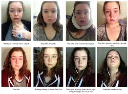 You'll likely have swelling and mild discomfort for 3 or. The Joy Of Wisdom Teeth Removal Healthier Stronger Happier