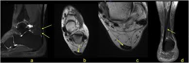Haglund's syndrome is a cause of retrocalcaneal pain. Els Jbs Prod Cdn Jbs Elsevierhealth Com Cms Att