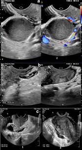 It's important to note that this method of classification may not reflect the severity of symptoms. Relationship Between The Severity Of Endometriosis Symptoms Dyspareunia Dysmenorrhea And Chronic Pelvic Pain And The Spread Of The Disease On Ultrasound Bmc Research Notes Full Text