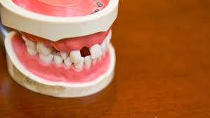 A filling is a way to restore a tooth damaged by decay back to its normal function and shape. Teeth Gap Filling Cost Dental News Network