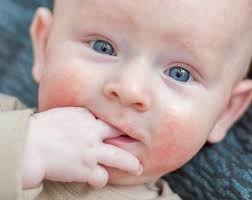 Immediately after coming out of the tub, parents. Baby Skin Conditions Boots