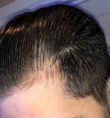 There are a lot of treatments out there that target male pattern baldness. Dermarolling Success 2 Months In Pictures Attached Hairlosstalk Forums