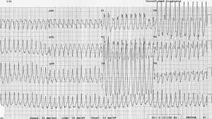 Pin On Ecg