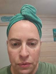 Mast cell flare causing bruise and swelling?