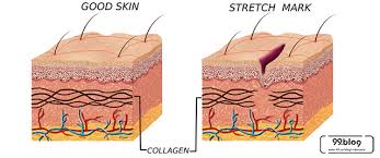 Fimela.com, memiliki stretch mark atau guratan pada kulit menjadi hal yang menjengkelkan. 17 Cara Menghilangkan Stretch Mark Secara Alami Medis