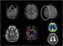 Novel Imaging Techniques In Cerebral Small Vessel Diseases And Vascular Cognitive Impairment Sciencedirect