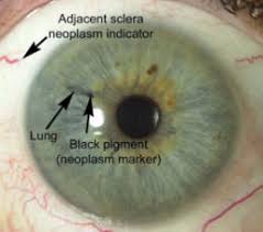 Understanding Iridology