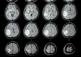 Associated with edematous face due to the compression of lymph ducts and veins with enlarged mediastinal lymph nodes, tumor of mediastinum, adhesive mediastinopericarditis, excessive effusion in the pleural and pericardial cavity. Immune Activating Gene Therapy For Glioblastoma The Scientist Magazine