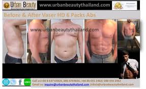 Pin On Fall In Love With A Valentine S Day Cosmetic Surgery Makeover Vaser Liposuction Bangkok