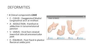 From this series of patients treated with comprehensive clubfoot release. Club Foot Ctev