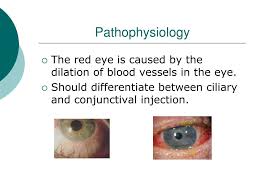Image result for Ciliary Flush
