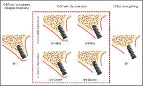 Purchase titanium mesh and necklaces here: Titanium Mesh For Bone Augmentation In Oral Implantology Current Application And Progress International Journal Of Oral Science