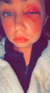 Recovery from severe facial injuries