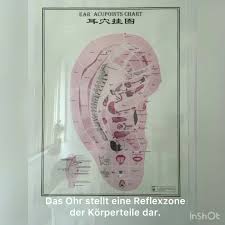 Akupunktur mit dauernadeln bei wirbelsäulenbeschwerdenin der allgemeinmedizinischen hausarztpraxis in stuttgart vaihingen. Chinamedic Zhang Posts Facebook