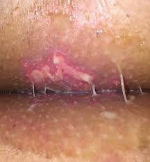 Yeast infection bumps on buttocks can be caused by a bacterial infection, over the counter medications, or just your normal. Yeast Infection Top Of Bum Crack