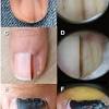 What does it feel like to have a throat cancer lump? 1