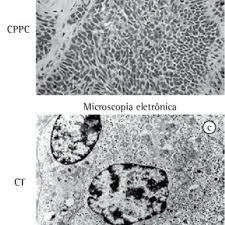 Carcinoid tumor is a rare type of tumor that usually grows slowly. Tumores Diagnosticados Microscopicamente Como Um Tumor Carcinoide Download Scientific Diagram