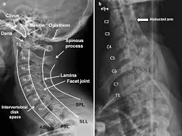 Please understand that our phone lines must be clear for urg. Radiologic Imaging Of The Spine Springerlink