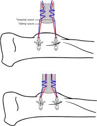 These are ideal to create a variety locking stitch patterns for avulsions of large tendons such as quadriceps, patellar, pectoral, or achilles. Surgical Technique For Single And Double Incision Method Of Acute Distal Biceps Tendon Repair Abstract Europe Pmc
