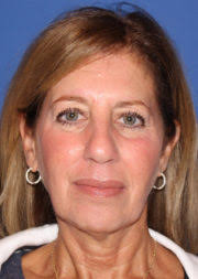 Neck Lift Before and After Photos