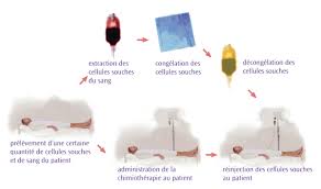 Différents traitements du lymphome non hodgkinien. Greffes De Cellules Souches Lymphoma Canada
