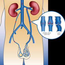 دوالي الخصية docteur wassim chaabane urologue centre urbain nord tunis