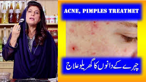 Check spelling or type a new query. Acne Pimples Home Treatment With Aloe Vera Acne Pimples Ka Ilaj In Urdu The Cook Book