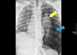 Pneumothorax Universitatsklinikum Freiburg