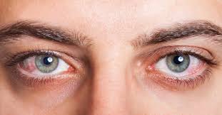 Most often, consuming weed and red eyes go together. How To Get Rid Of Weed Induced Red Eyes Cannasos