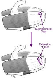 Repair Of Rotator Cuff Tears Uw Orthopaedics And Sports Medicine Seattle