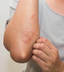 Postpartum Hives Causes Symptoms Treatment And Remedies