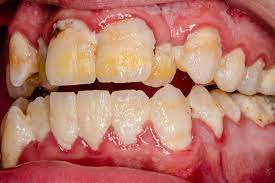 Prevotella Intermedia Is A Species That Is Found In Gingival Crevices It Is Commonly Found In Patients Who Periodontal Disease Poor Nutrition Disease Symptoms