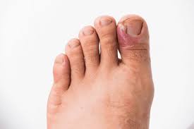 Image result for Onychotillomania feet