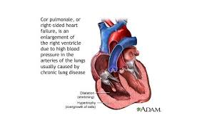 Health Problems That Complicate Effects Of Copd Right Sided Heart Failure Heart Failure Copd
