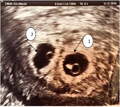 Check spelling or type a new query. Ultrasound Examination Showed An Intrauterine Twin Pregnancy 1 2 At Download Scientific Diagram