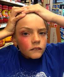 Jellyfish leaving their stinging mark