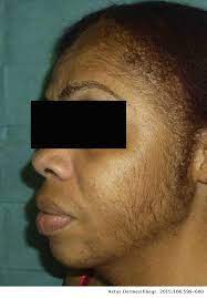 Hirsutism is often caused by a simple hormonal imbalance. Generalized Hypertrichosis Due To Topical Minoxidil Actas Dermo Sifiliograficas