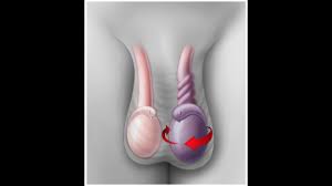 If your test results are normal, your chance of getting cervical cancer in the next few years is very low. Testicular Torsion Youtube