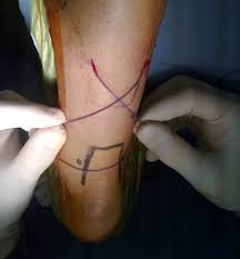 La rottura del tendine d'achille è un'evenienza che riguarda 1 persona ogni 10000 l'anno, sono colpiti principalmente gli uomini di età compresa tra i 30 ed i 40 anni, con un rischio fino a 5 volte maggiore rispetto alle donne; Rottura Sottocutanea Acuta Del Tendine D Achille Dr Marcello Zavatta