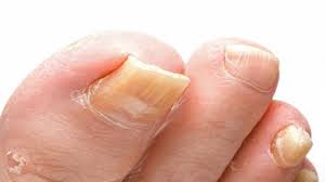 Nagelpilz Viele Wissen Nichts Von Der Drohenden Gefahr Nagelpilz Nagelpilz Hausmittel Was Tun Gegen Nagelpilz