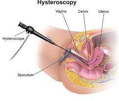 Hysteroscopy Procedure Uterine Polyp Removal Specialist Dr Mariz Nyc